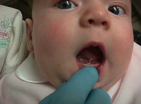 anquiloglossia bebe
