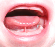 Anquiloglossia, freio curto da lingua, frenulo lingual curto, tong tie, frenotomia, pediatria descomplicada