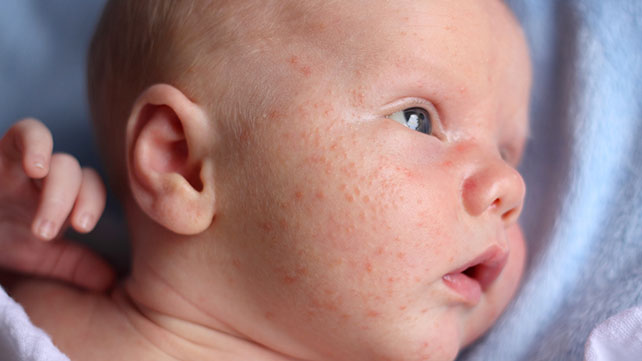 Brotoeja Miliária Ou Dermatite Do Calor O Que é Pediatria Descomplicada