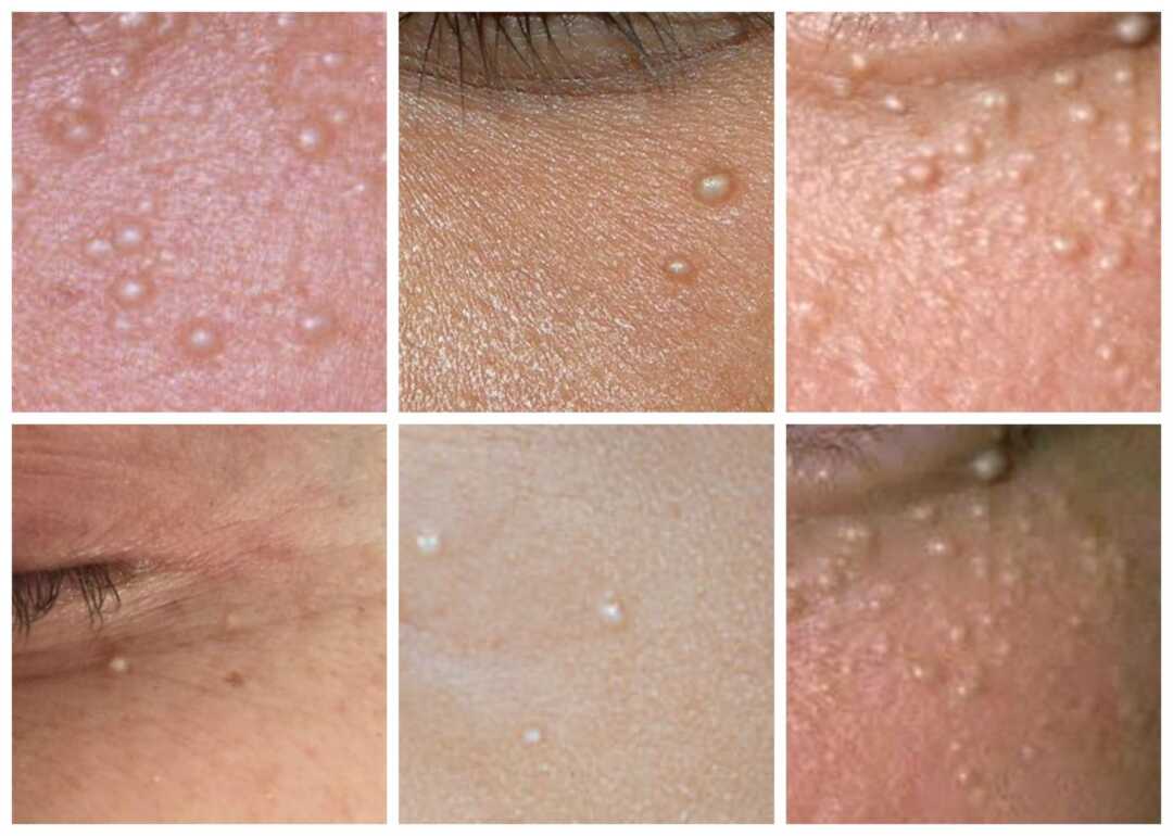 Cistos De Milium Pediatria Descomplicada Cistos De Milium Pediatria Descomplicada