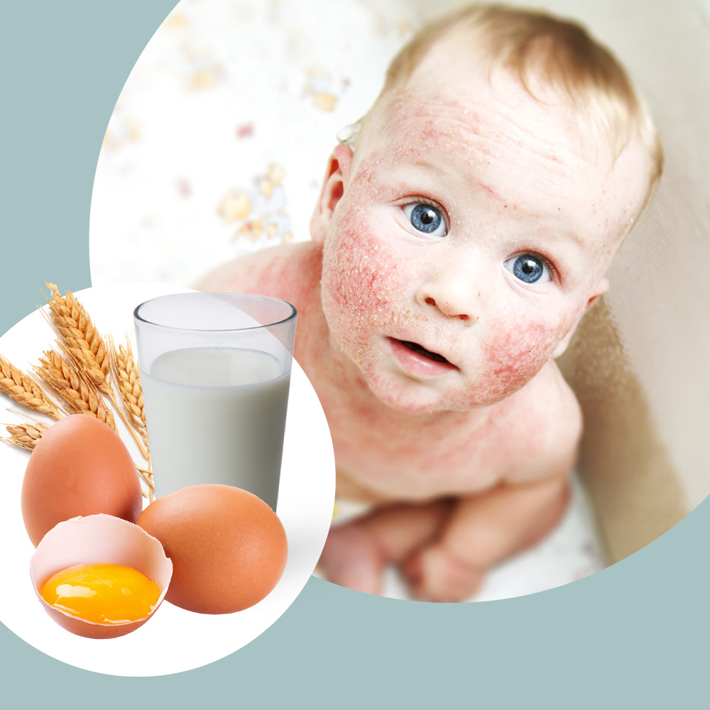 Dermatite atópica e alimentação, como a alimentação pode afetar a pele?