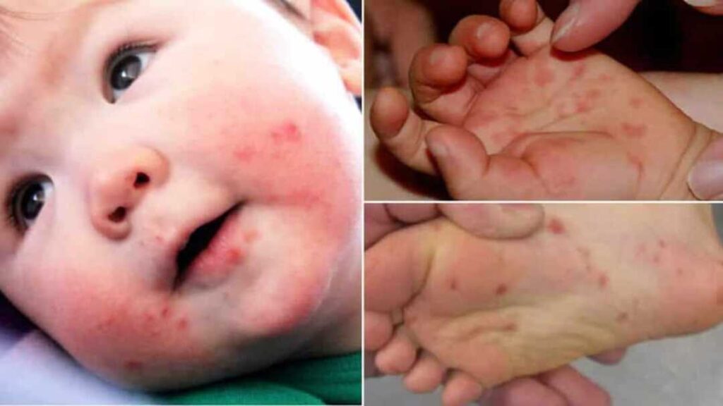 O que é a doença mão-pé-boca e como tratar? - Pediatria Descomplicada