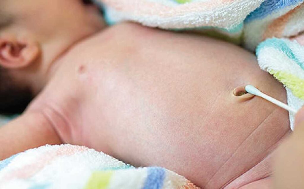 Cuidados com o umbigo do recém-nascido - Pediatria Descomplicada
